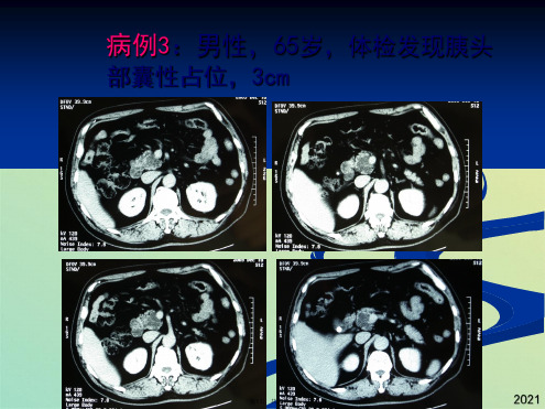 胰腺囊性肿瘤诊治2(共20张PPT)