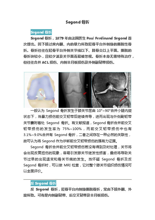 Segond骨折