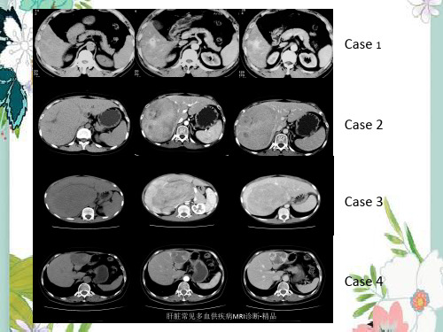 肝脏常见多血供疾病MRI诊断-精品