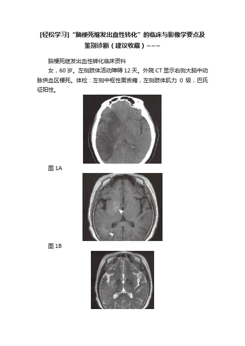 [轻松学习]“脑梗死继发出血性转化”的临床与影像学要点及鉴别诊断（建议收藏）~~~