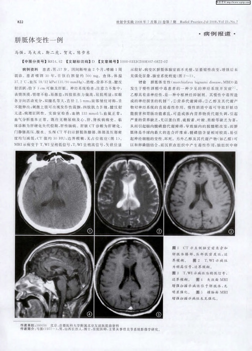 胼胝体变性一例