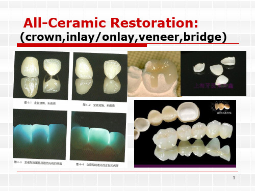 口腔学英文课件:All-Ceramic Restoration
