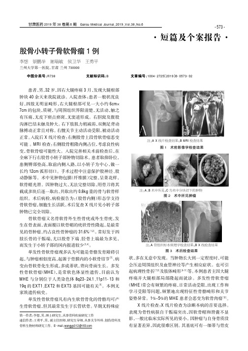 股骨小转子骨软骨瘤1例