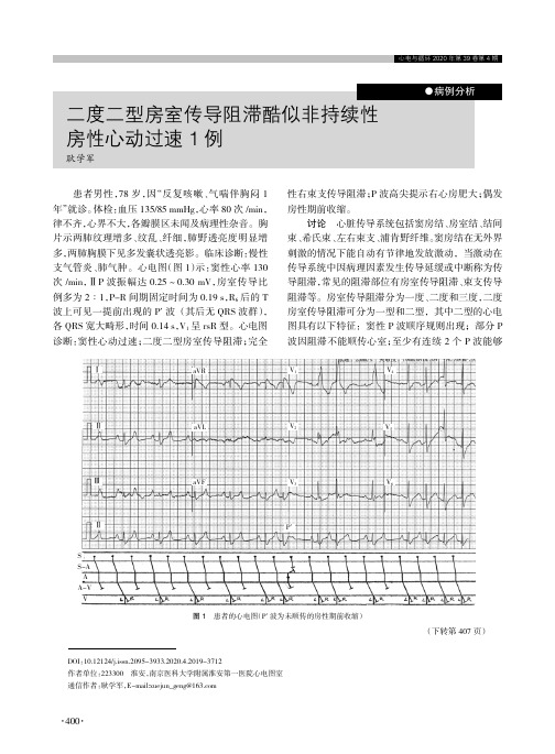 二度二型房室传导阻滞酷似非持续性房性心动过速1例