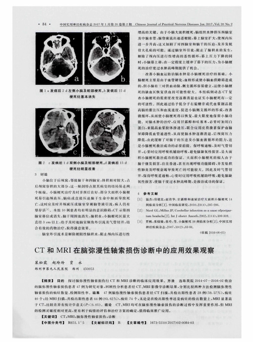 CT和MRI在脑弥漫性轴索损伤诊断中的应用效果观察