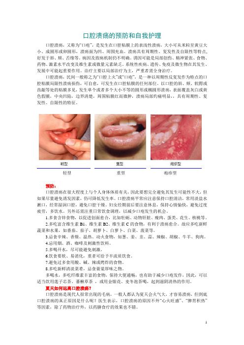 口腔溃疡