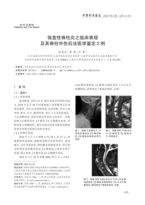 强直性脊柱炎之临床表现及其脊柱外伤后法医学鉴定2例