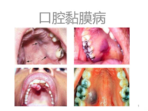 口腔黏膜病的鉴别PPT课件