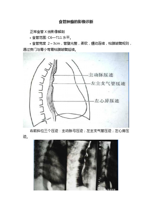 食管肿瘤的影像诊断