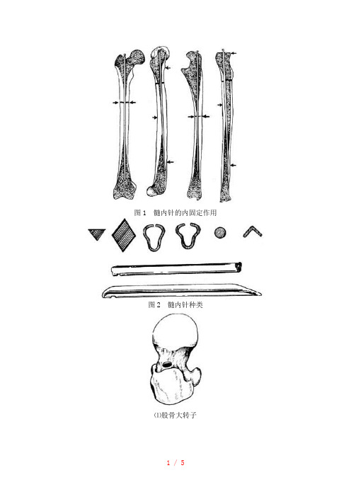 髓内针图解1