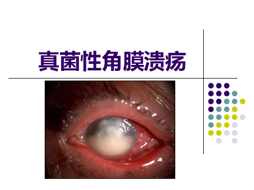 真菌性角膜炎