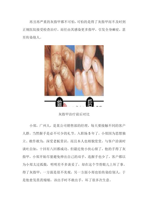 俊小伙职场“遇难”,灰指甲让人怕握手