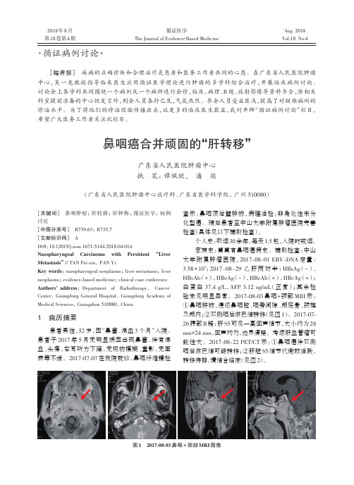 鼻咽癌合并顽固的“肝转移”