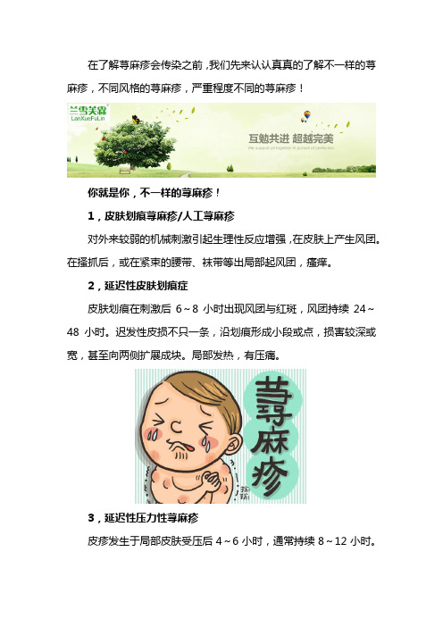 夏季出现的荨麻疹会传染吗？