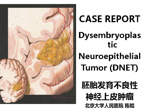 胚胎发育不良性神经上皮肿瘤