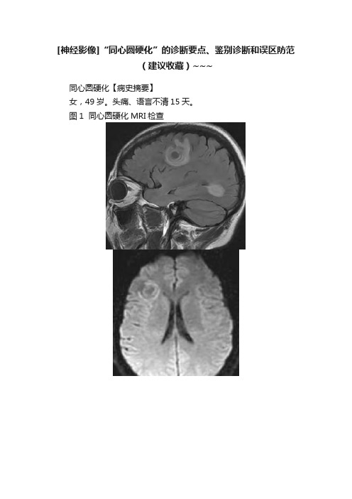 [神经影像]“同心圆硬化”的诊断要点、鉴别诊断和误区防范（建议收藏）~~~