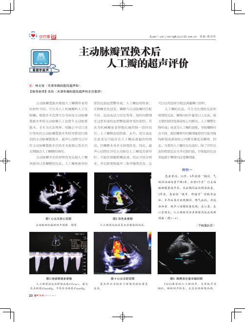 主动脉瓣置换术后人工瓣的超声评价