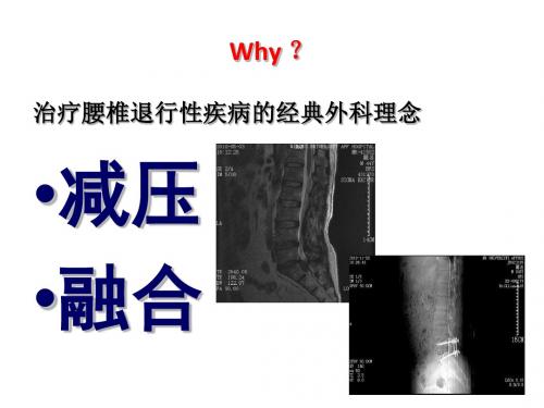 DYNESYS在腰椎退行性变中的应用