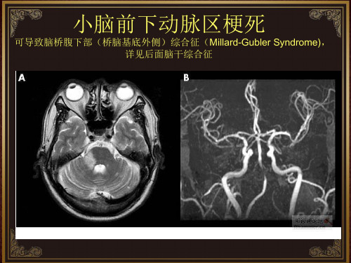 脑血管解剖及脑梗塞定位诊断-迷路动脉(1)