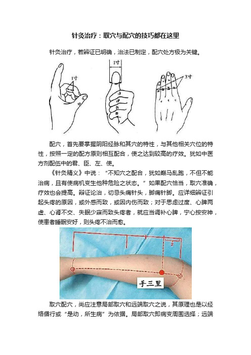 针灸治疗：取穴与配穴的技巧都在这里