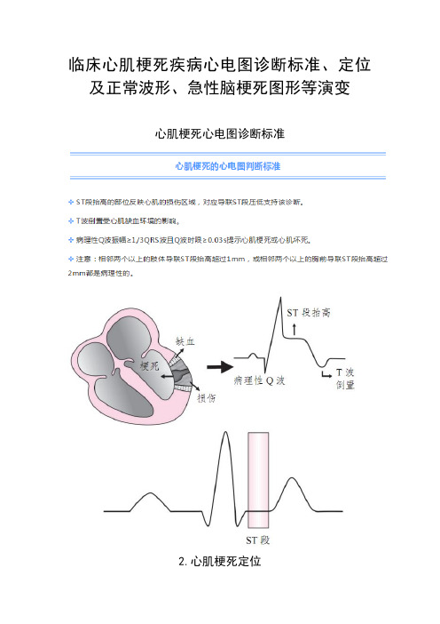 临床心肌梗死疾病心电图诊断标准、定位及正常波形、急性脑梗死图形等演变