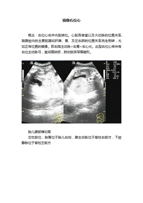 镜像右位心