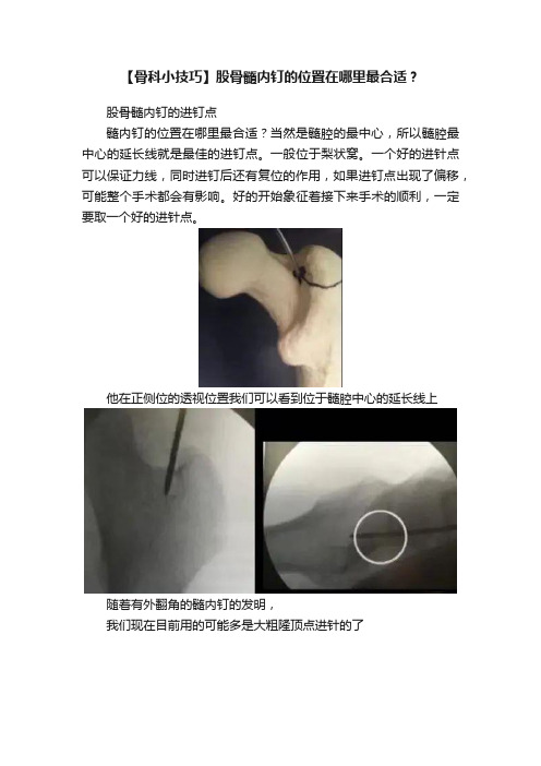 【骨科小技巧】股骨髓内钉的位置在哪里最合适？