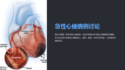 急性心梗病例讨论