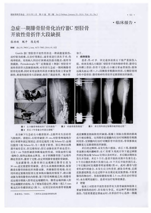 急症一期腓骨胫骨化治疗ⅢC型胫骨开放性骨折伴大段缺损