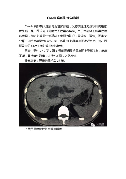 Caroli病的影像学诊断