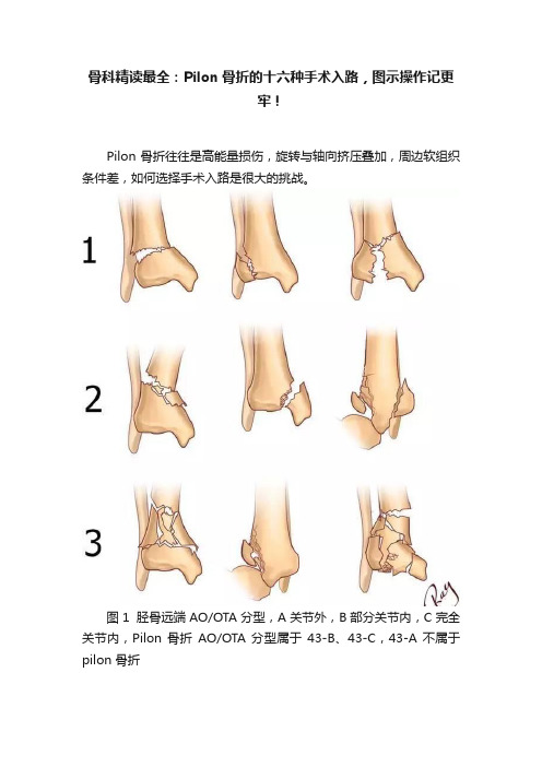 骨科精读最全：Pilon骨折的十六种手术入路，图示操作记更牢！