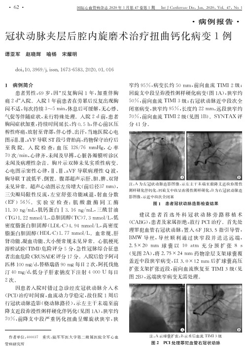 冠状动脉夹层后腔内旋磨术治疗扭曲钙化病变1例