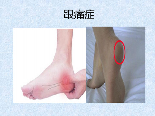 跟痛症