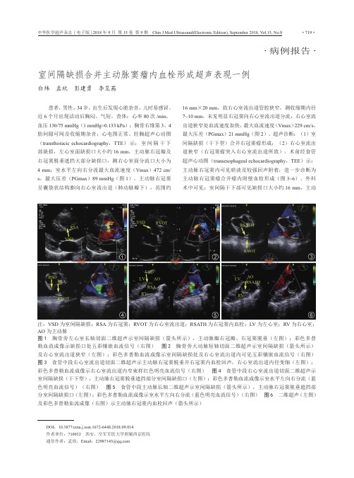 室间隔缺损合并主动脉窦瘤内血栓形成超声表现-例