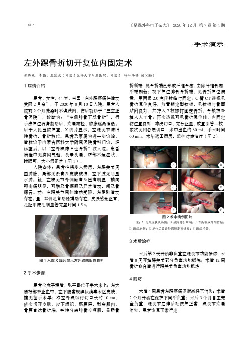 左外踝骨折切开复位内固定术