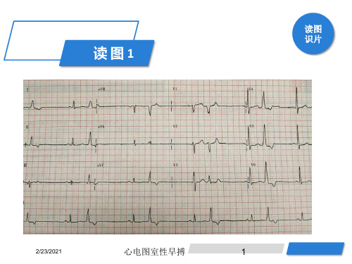 心电图室性早搏课件