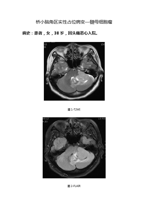 桥小脑角区实性占位病变—髓母细胞瘤