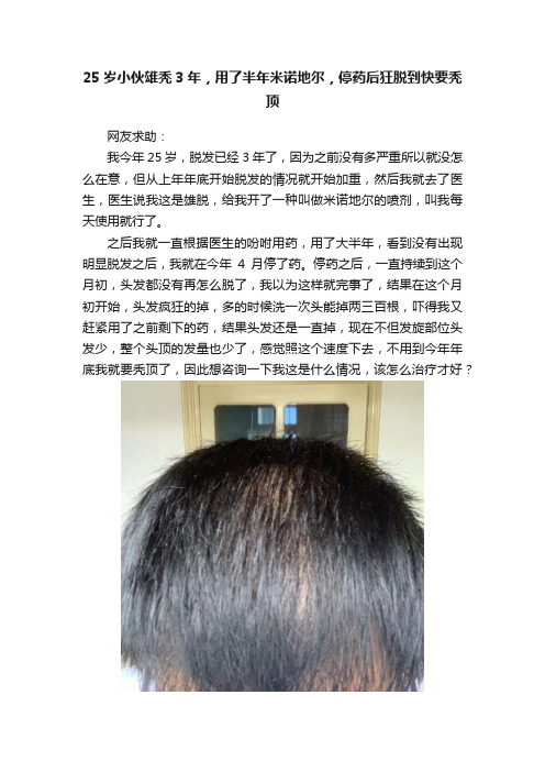 25岁小伙雄秃3年，用了半年米诺地尔，停药后狂脱到快要秃顶