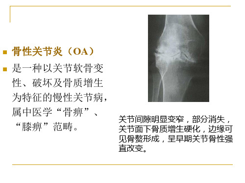 骨性关节炎