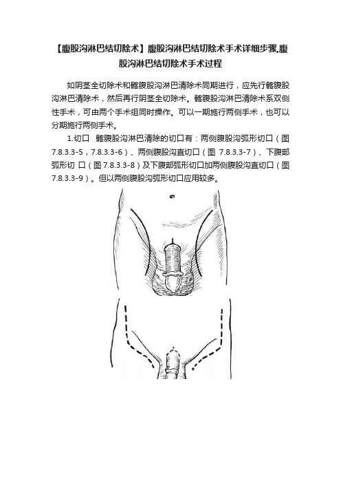 【腹股沟淋巴结切除术】腹股沟淋巴结切除术手术详细步骤,腹股沟淋巴结切除术手术过程