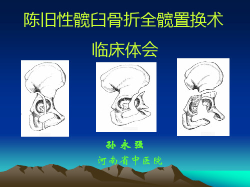 陈旧性髋臼骨折人工关节置换