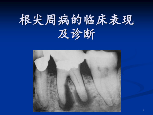 根尖周病的临床表现及诊断PPT课件