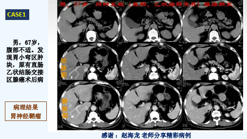 胃神经鞘瘤影像表现(修改后)