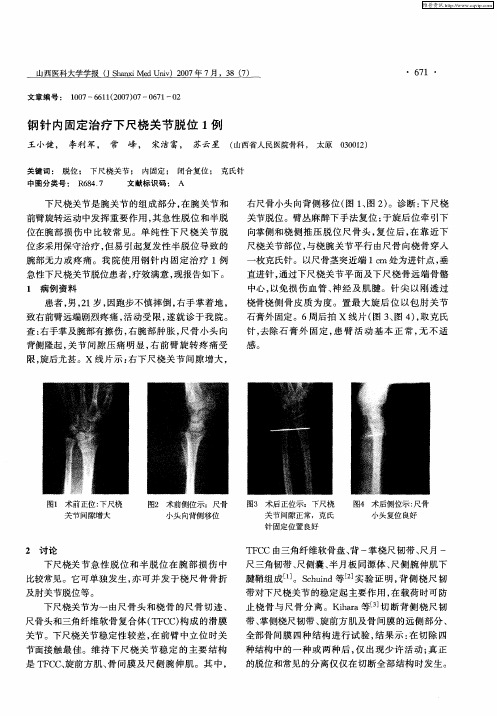 钢针内固定治疗下尺桡关节脱位1例