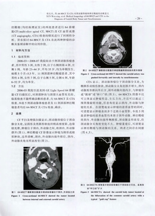 64-MSCT及CTA对颈动脉体瘤和神经鞘瘤的诊断意义