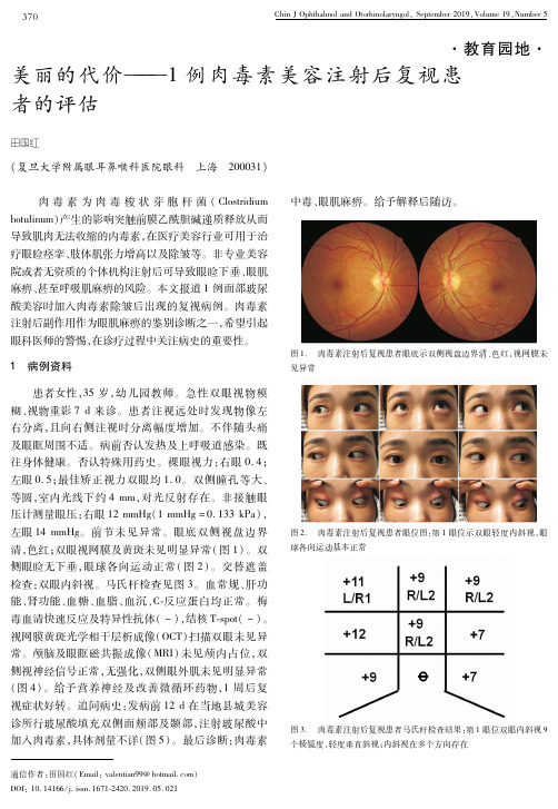 美丽的代价--1例肉毒素美容注射后复视患者的评估