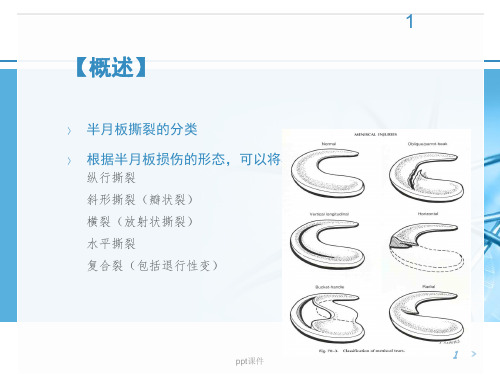 半月板撕裂的治疗ppt课件