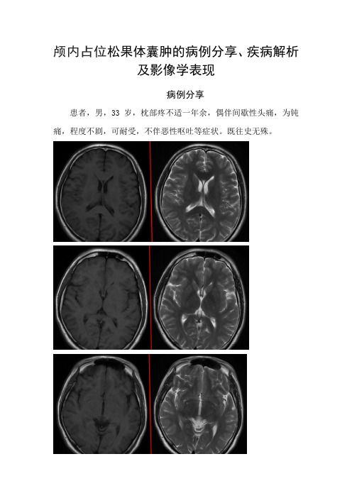 颅内占位松果体囊肿的病例分享、疾病解析及影像学表现