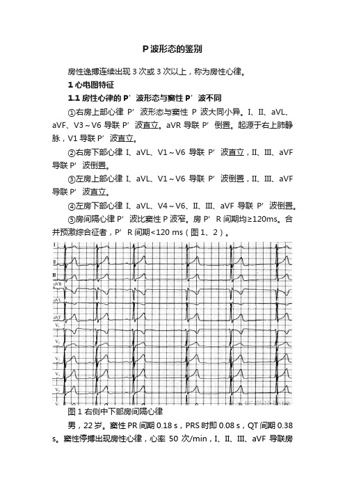 P波形态的鉴别