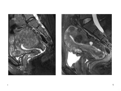 子宫腺肌症的MRI诊断PPT课件
